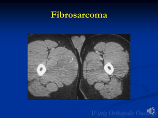 Fibrosarcoma
 