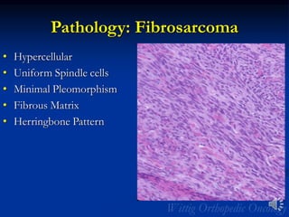 Pathology: Fibrosarcoma
• Hypercellular
• Uniform Spindle cells
• Minimal Pleomorphism
• Fibrous Matrix
• Herringbone Pattern
 
