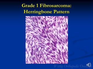 Grade 1 Fibrosarcoma:
Herringbone Pattern
 