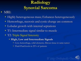 Radiology
Synovial Sarcoma
• MRI:
• Highly heterogeneous mass; Enhances heterogeneously
• Hemorrhage, necrosis and cystic change are common
• Lobular growth with internal septations
• T1: Intermediate signal similar to muscle
• T2: Triple Signal Intensity
• High, Low and Intermediate Signals
• Cyst, hemorrhage, solid elements, fibrous tissue in same tumor
• Fluid-Fluid levels in 25% of patients
 