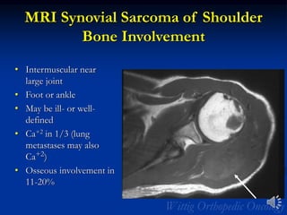 MRI Synovial Sarcoma of Shoulder
Bone Involvement
• Intermuscular near
large joint
• Foot or ankle
• May be ill- or well-
defined
• Ca+2 in 1/3 (lung
metastases may also
Ca+2)
• Osseous involvement in
11-20%
 