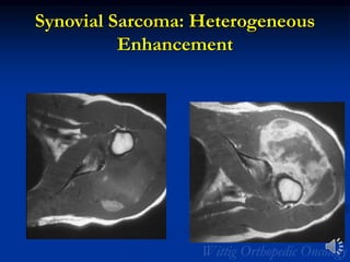 Synovial Sarcoma: Heterogeneous
Enhancement
 