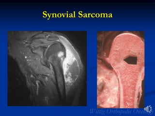 Synovial Sarcoma
 