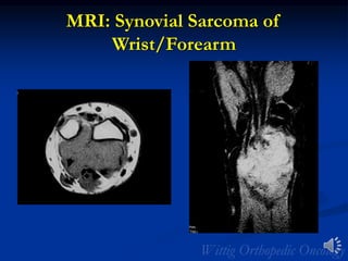 MRI: Synovial Sarcoma of
Wrist/Forearm
 