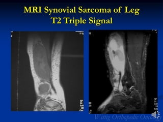 MRI Synovial Sarcoma of Leg
T2 Triple Signal
 