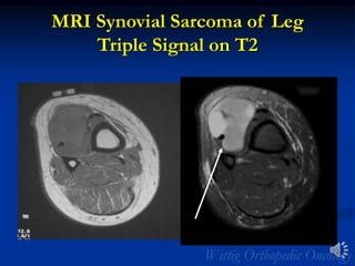 MRI Synovial Sarcoma of Leg
Triple Signal on T2
 
