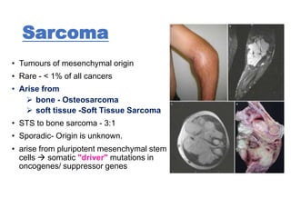 SOFT TISSUE SARCOMA | PPTX
