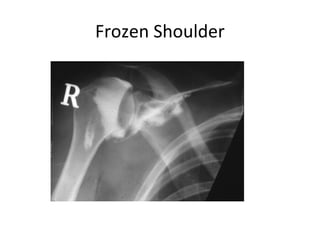 Frozen Shoulder

 