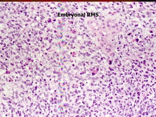 Soft tissue toumours in children | PDF