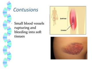 SoftTissue Trauma and causes sign symptoms | PDF