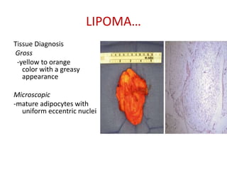 LIPOMA…
Tissue Diagnosis
Gross
-yellow to orange
color with a greasy
appearance
Microscopic
-mature adipocytes with
uniform eccentric nuclei
 