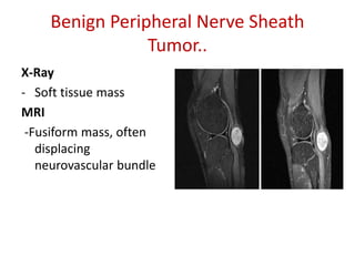Benign Peripheral Nerve Sheath
Tumor..
X-Ray
- Soft tissue mass
MRI
-Fusiform mass, often
displacing
neurovascular bundle
 