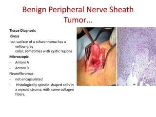 Benign Peripheral Nerve Sheath
Tumor…
Tissue Diagnosis
Gross
-cut surface of a schwannoma has a
yellow-gray
color, sometimes with cystic regions
Microscopic
- Antoni A
- Antoni B
Neurofibromas-
- not encapsulated
- Histologically spindle-shaped cells in
a myxoid stroma, with some collagen
fibers.
 