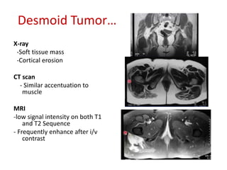 Desmoid Tumor…
X-ray
-Soft tissue mass
-Cortical erosion
CT scan
- Similar accentuation to
muscle
MRI
-low signal intensity on both T1
and T2 Sequence
- Frequently enhance after i/v
contrast
 