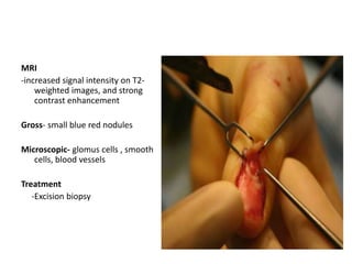 MRI
-increased signal intensity on T2-
weighted images, and strong
contrast enhancement
Gross- small blue red nodules
Microscopic- glomus cells , smooth
cells, blood vessels
Treatment
-Excision biopsy
 