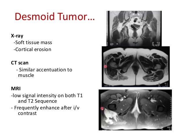 Soft Tissue Tumor