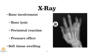 X-Ray
• Bone involvement
• Bone lysis
• Periosteal reaction
• Pressure effect
• Soft tissue swelling
17
 