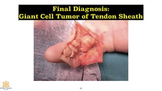 45
Final Diagnosis:
Giant Cell Tumor of Tendon Sheath
 