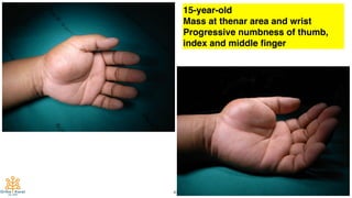 47
15-year-old
Mass at thenar area and wrist
Progressive numbness of thumb,
index and middle ﬁnger
 