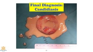 57
Final Diagnosis:
Candidiasis
 