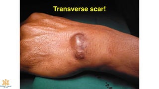 60
Transverse scar!
 