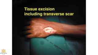 64
Tissue excision
including transverse scar
 