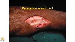 65
Paratenon was intact
 