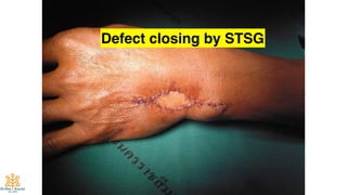 66
Defect closing by STSG
 