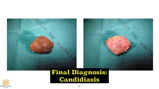 67
Final Diagnosis:
Candidiasis
 
