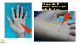 73
35-year-old, M
Painful mass at left
palm for 4 mo.
 