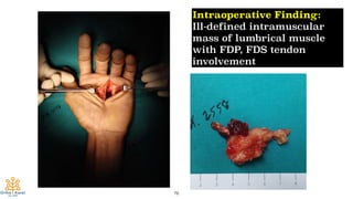 76
Intraoperative Finding:
Ill-defined intramuscular
mass of lumbrical muscle
with FDP, FDS tendon
involvement
 