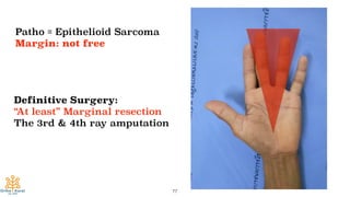 77
Patho = Epithelioid Sarcoma
Margin: not free
Definitive Surgery:
“At least” Marginal resection
The 3rd & 4th ray amputation
 