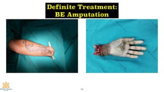 79
Definite Treatment:
BE Amputation
 