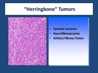 “Herringbone” Tumors
• Synovial sarcoma
• Neurofibrosarcoma
• Solitary Fibrous Tumor
 