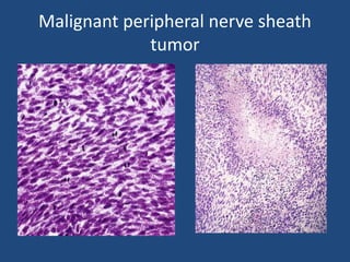 Malignant peripheral nerve sheath
tumor
 