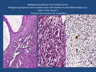 Malignant peripheral nerve sheath tumor,
Malignant peripheral nerve sheath tumor with skeletal muscle differentiation (so-
called ‘triton tumor’).
, Positive immunostain for myoglobin
 