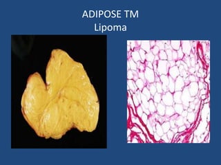 ADIPOSE TM
Lipoma
 