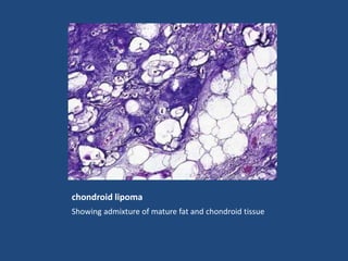 chondroid lipoma
Showing admixture of mature fat and chondroid tissue
 
