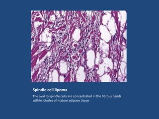 Spindle cell lipoma
The oval to spindle cells are concentrated in the fibrous bands
within lobules of mature adipose tissue
 