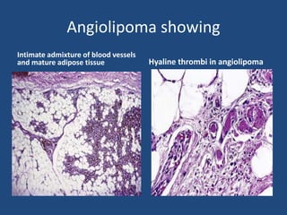 Angiolipoma showing
Intimate admixture of blood vessels
and mature adipose tissue Hyaline thrombi in angiolipoma
 