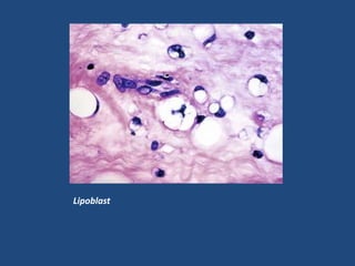 Lipoblast
 