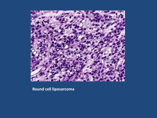 Round cell liposarcoma
 