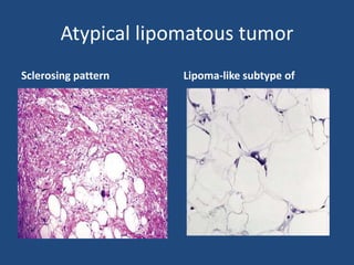 Atypical lipomatous tumor
Sclerosing pattern Lipoma-like subtype of
 