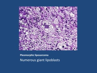 Pleomorphic liposarcoma
Numerous giant lipoblasts
 