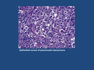 Epithelioid variant of pleomorphic liposarcoma
 