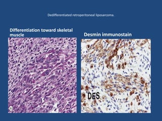 Desmin immunostain
Differentiation toward skeletal
muscle
Dedifferentiated retroperitoneal liposarcoma.
 