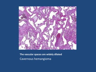 The vascular spaces are widely dilated
Cavernous hemangioma
 