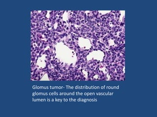 Glomus tumor- The distribution of round
glomus cells around the open vascular
lumen is a key to the diagnosis
 