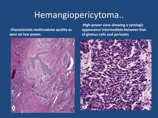 Hemangiopericytoma..
Characteristic multinodular quality as
seen on low power.
High-power view showing a cytologic
appearance intermediate between that
of glomus cells and pericytes
 