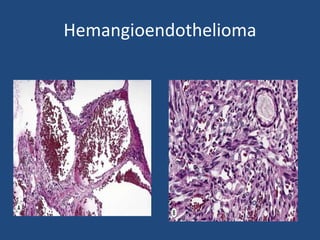 Hemangioendothelioma
 